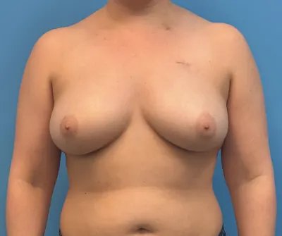Breast Reconstruction Case #28689 — before, Dr. Samir Rao
