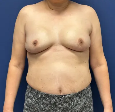 Breast Reconstruction Case #28751 — after, Dr. Samir Rao