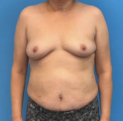 Breast Reconstruction Case #28751 — before, Dr. Samir Rao