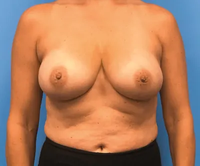 Breast Reconstruction Case #294 — before, Dr. Samir Rao