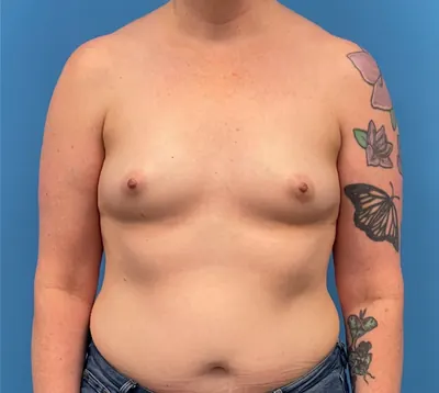 Breast Reconstruction Case #335 — before, Dr. Samir Rao