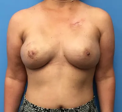Breast Reconstruction Case #400 — after, Dr. Samir Rao