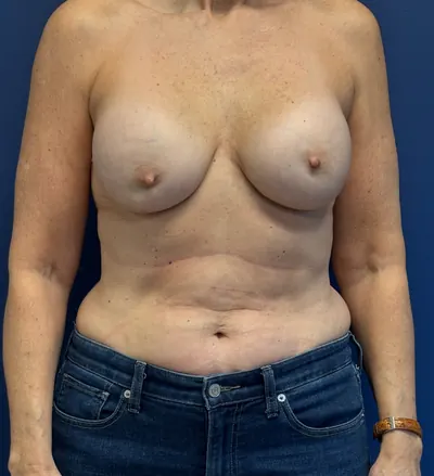 Breast Reconstruction Case #4864 — before, Dr. Frank Albino
