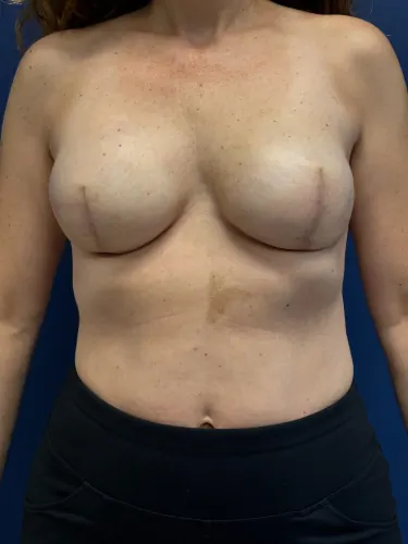 Breast Reconstruction Case #6069 — after, Dr. Frank Albino