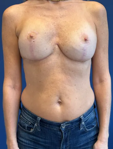 Breast Reconstruction Case #8978 — after, Dr. Frank Albino