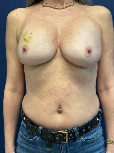 Breast Reconstruction Case #8978 — before, Dr. Frank Albino