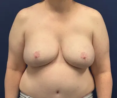 Breast Reconstruction Case #26029 — after, Dr. Samir Rao