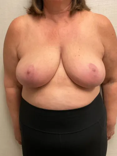 Breast Reduction Case #26425 — after, Dr. Arjun Kanuri