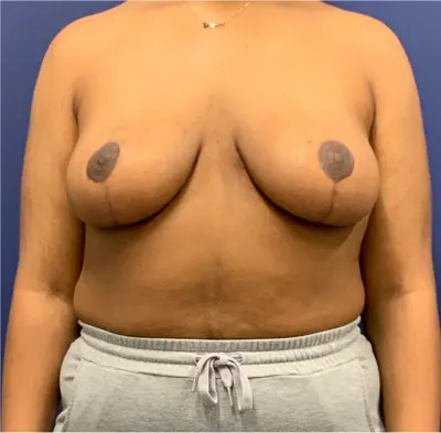 Breast Reduction Case #3 — after, Dr. Arjun Kanuri