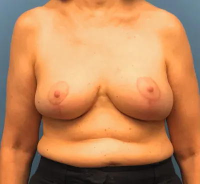 Breast Reduction Case #13180 — after, Dr. Samir Rao