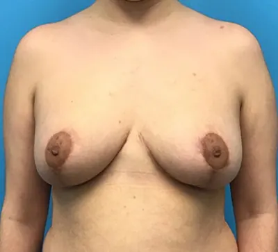 Breast Reduction Case #132 — after, Dr. Samir Rao