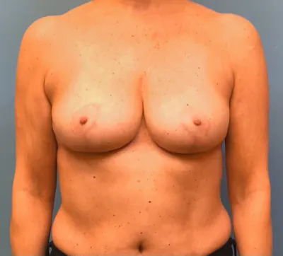 Breast Reduction Case #13839 — after, Dr. Samir Rao