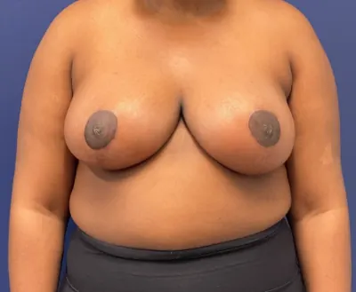 Breast Reduction Case #240 — after, Dr. Samir Rao