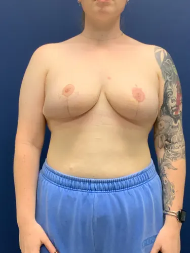 Breast Reduction Case #2527 — after, Dr. Frank Albino