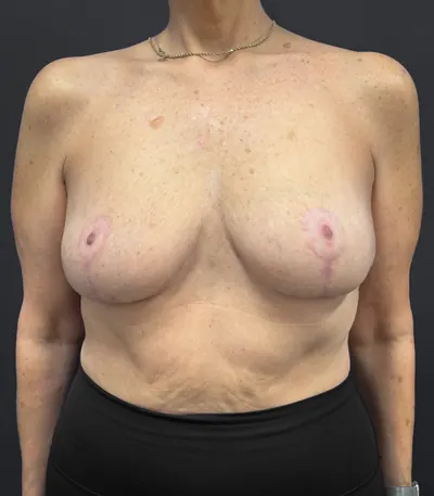 Breast Reduction Case #2583 — after, Dr. Arjun Kanuri
