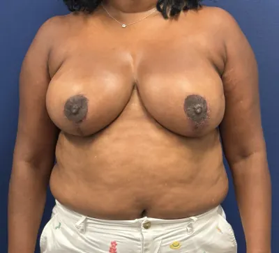 Breast Reduction Case #28242 — after, Dr. Samir Rao