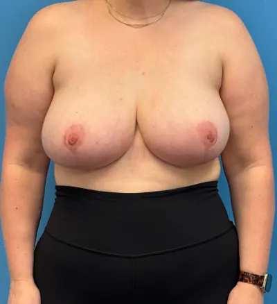Breast Reduction Case #28338 — after, Dr. Samir Rao