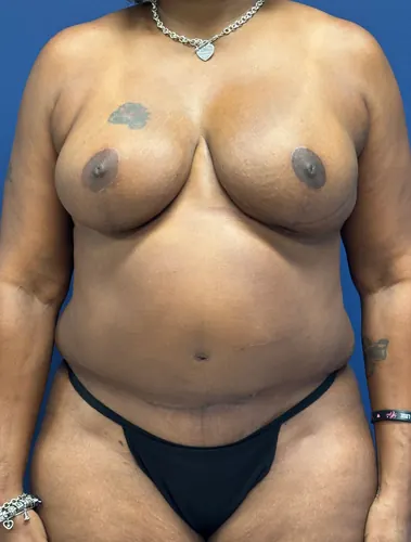 Breast Reduction Case #4053 — after, Dr. Frank Albino