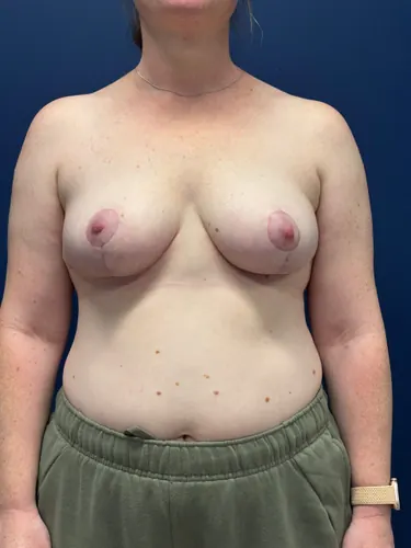 Breast Reduction Case #5738 — after, Dr. Frank Albino