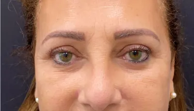 Brow Lift Case #6540 — after, Dr. Arjun Kanuri