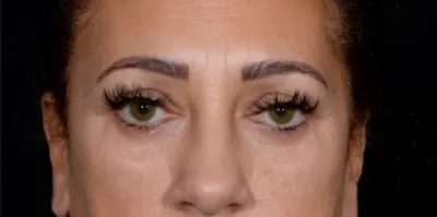 Brow Lift Case #6540 — before, Dr. Arjun Kanuri