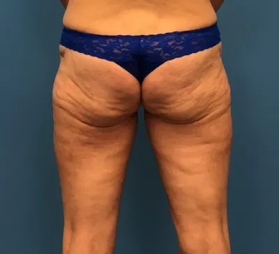 Liposuction Case #10165 — after, Dr. Samir Rao