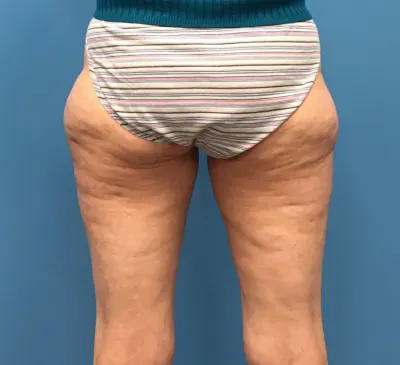 Liposuction Case #10165 — before, Dr. Samir Rao