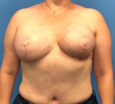 Breast Reconstruction Case #10685 — after, Dr. Samir Rao