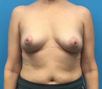 Breast Reconstruction Case #12659 — before, Dr. Samir Rao