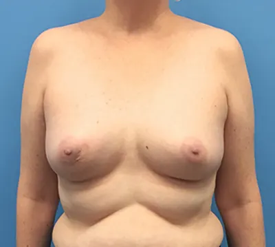 Breast Reconstruction Case #135 — before, Dr. Samir Rao