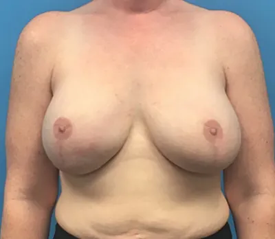 Breast Reconstruction Case #137 — after, Dr. Samir Rao