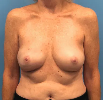 Breast Reconstruction Case #13861 — after, Dr. Samir Rao