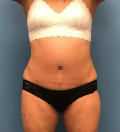 Tummy Tuck Case #14819 — after, Dr. Samir Rao