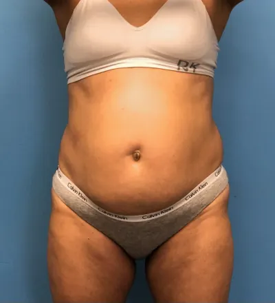 Tummy Tuck Case #14819 — before, Dr. Samir Rao