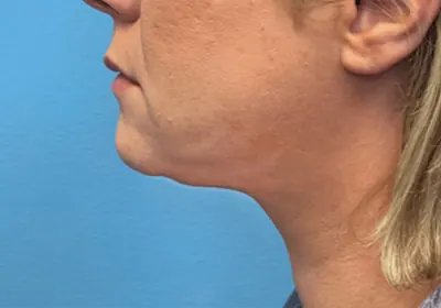 Submental Liposuction Case #20811 — after, Dr. Samir Rao