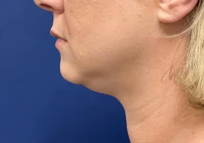 Submental Liposuction Case #20811 — before, Dr. Samir Rao