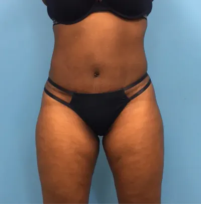 Tummy Tuck Case #246 — after, Dr. Samir Rao