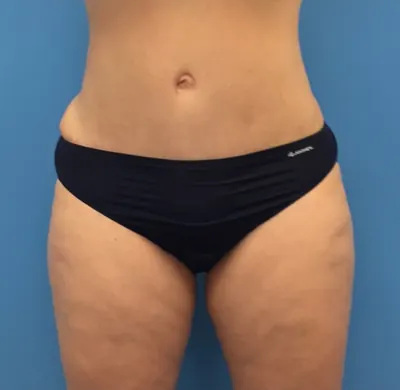 Tummy Tuck Case #248 — after, Dr. Samir Rao
