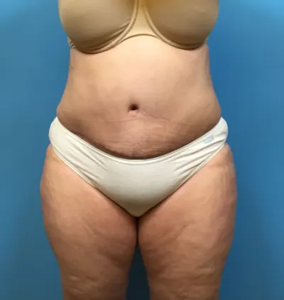 Tummy Tuck Case #249 — after, Dr. Samir Rao