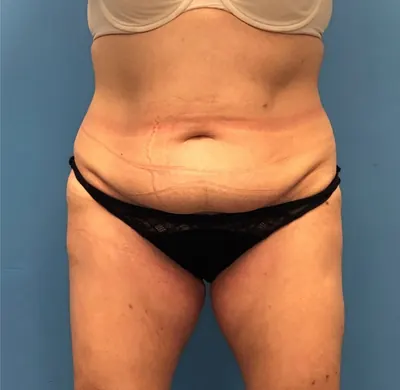Tummy Tuck Case #251 — before, Dr. Samir Rao