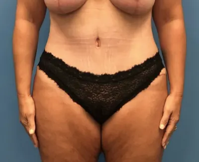 Tummy Tuck Case #252 — after, Dr. Samir Rao