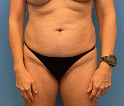Tummy Tuck Case #253 — before, Dr. Samir Rao