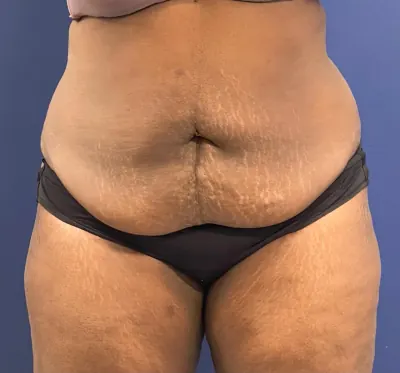 Tummy Tuck Case #257 — before, Dr. Samir Rao