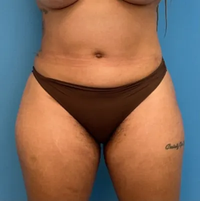 Liposuction Case #25704 — after, Dr. Samir Rao