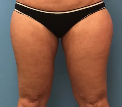 Liposuction Case #278 — after, Dr. Samir Rao