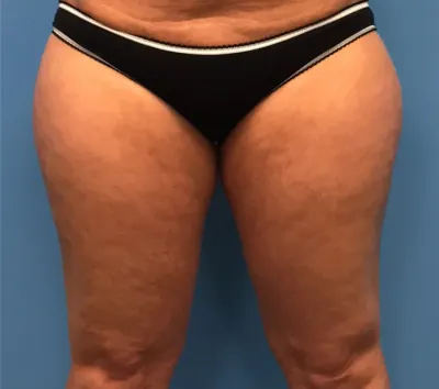 Liposuction Case #278 — before, Dr. Samir Rao
