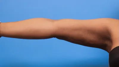 Liposuction Case #279 — after, Dr. Samir Rao