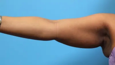 Liposuction Case #279 — before, Dr. Samir Rao