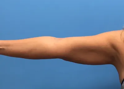 Liposuction Case #280 — after, Dr. Samir Rao