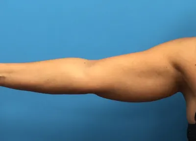 Liposuction Case #280 — before, Dr. Samir Rao